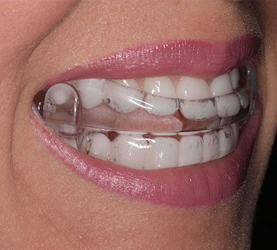 Oral Appliance Therapy