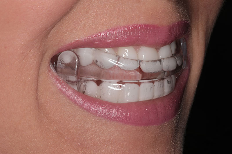 The Oral Appliance