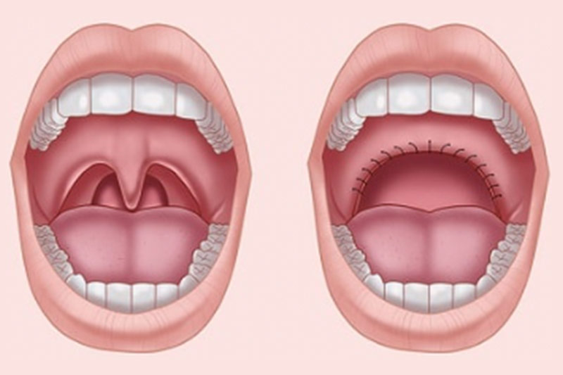 Surgical Treatments